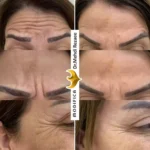 بوتاکس