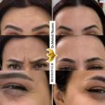 بوتاکس 1