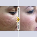 جوانسازی اسکار جوش 1