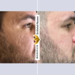 جوانسازی اسکار جوش