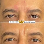 فیلر خط اخم 1