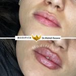 lip filler gallery