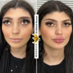 فیلر لب 12