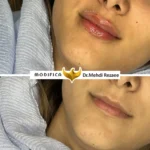 فیلر لب 10