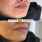 فیلر لب 3