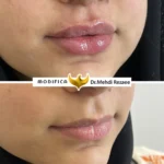 فیلر لب 5