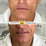 فیلر خط خنده1