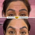 بوتاکس 2