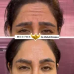 بوتاکس 3