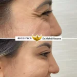 بوتاکس 4