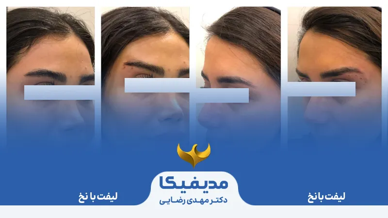 لیفت با نخ