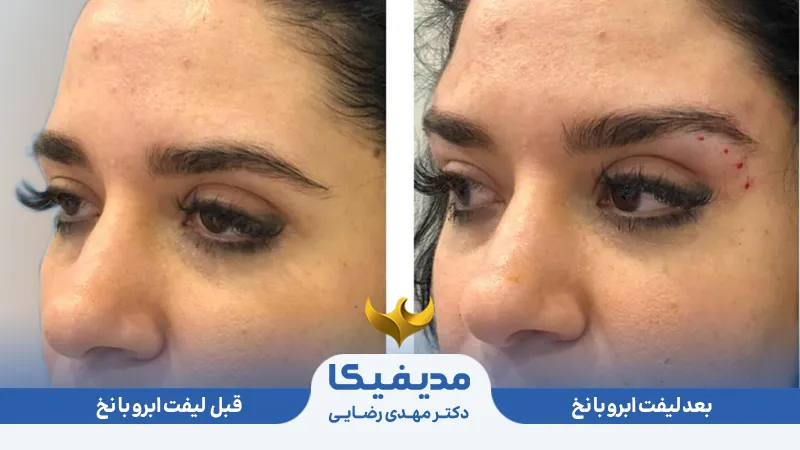لیفت صورت با نخ 