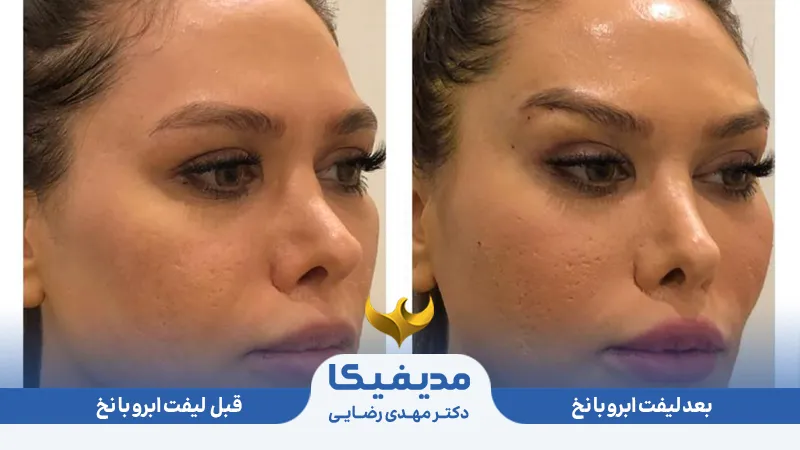 لیفت با نخ