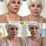هایفو 1