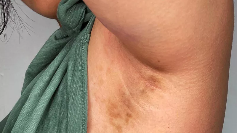 Skin spots after laser