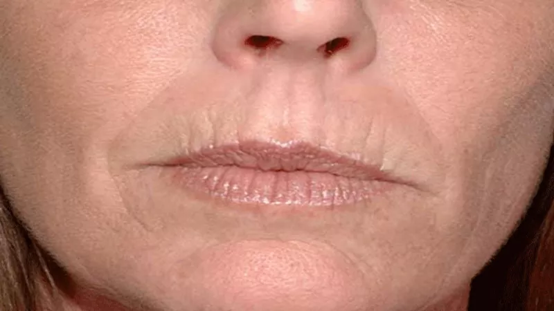 Treatment of wrinkles around the lips