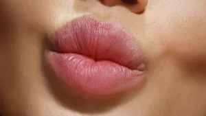تزریق ژل لب قلوه ای + هزینه فیلر لب قلوه ای