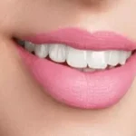 تزریق ژل لب مدل هالیوودی + هزینه ژل لب هالیوودی در مازندران