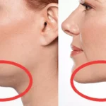 مزوتراپی غبغب + مزایا و هزینه مزو غبغب