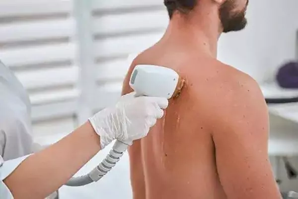 لیزر مو های زائد کمر
