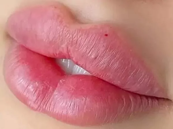 تزریق ژل لب مدل چاک دار؛ راهنمای کامل انتخاب، مزایا و روش اجرا